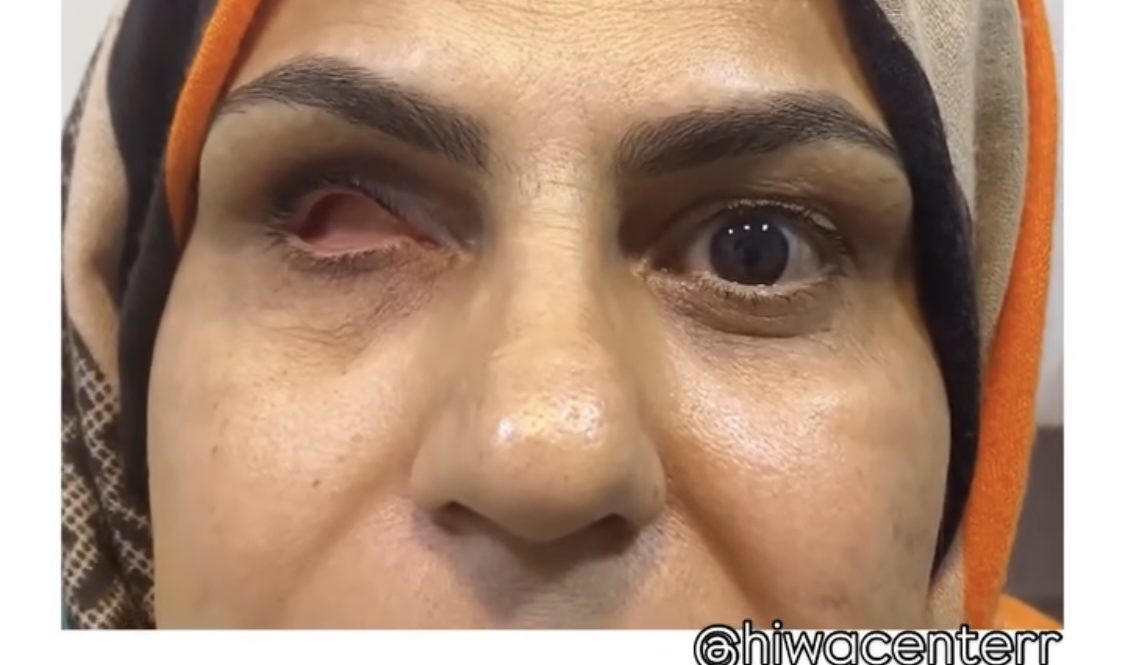 پروتز چشم